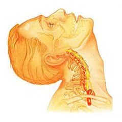 Osteochondróza krčnej chrbtice