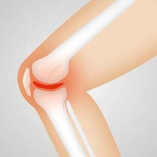 artróza je nezápalová patológia kĺbov