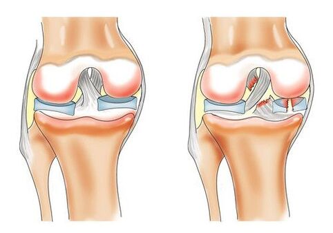 zdravé koleno a artróza kolenného kĺbu