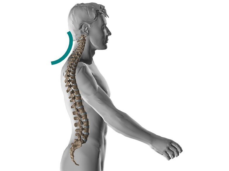 Cervikálna osteochondróza chrbtice, ktorá spôsobuje veľa nepríjemných symptómov